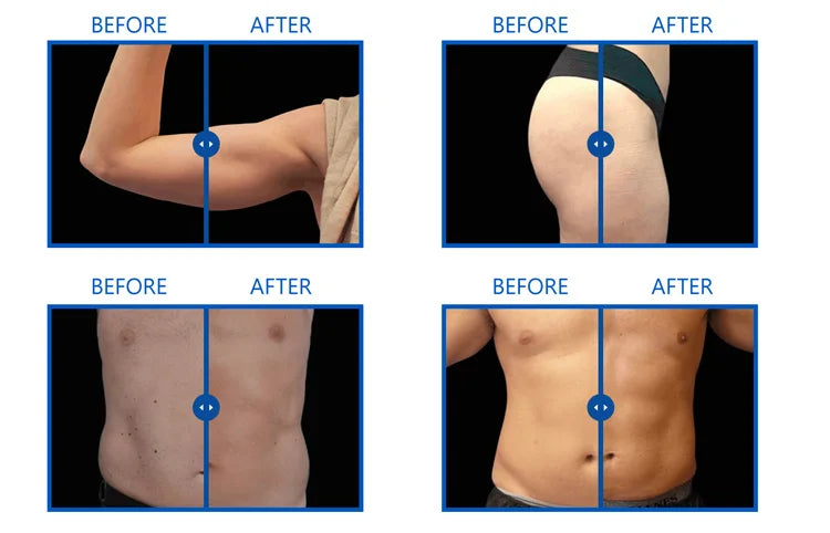 EMS Body Slimming Machine MuscleEMS Electrical Stimulation Muscle Sculpt Fat Burning Control Carving Weight Loss Machine